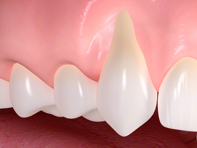 Freiliegender Zahn durch Zahnfleischschwund