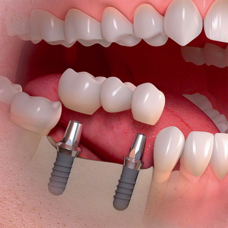 Unterkiefer mit mehreren fehlenden Zähnen