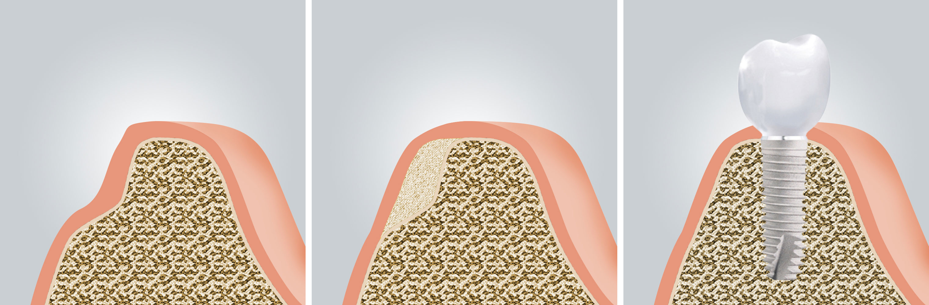 Für eine Implantation muss ausreichend Knochenvolumen vorhanden sein. Auch Patienten, die nach langer Zahnlosigkeit Knochen verloren haben, kann geholfen werden